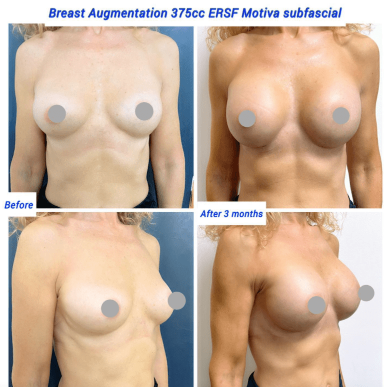 Before and after breast augmentation 375cc Motiva subfasical
