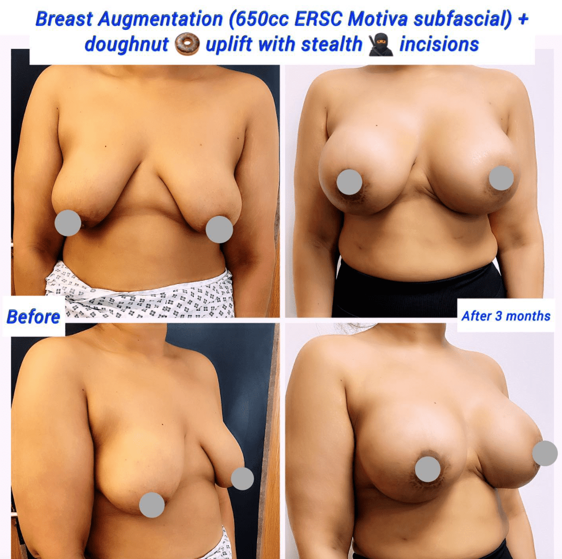 Before and after breast augmentation and doughnut uplift