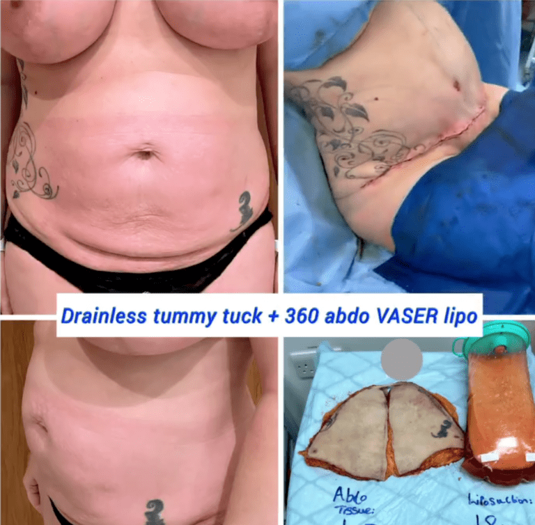 Drainless tummy tuck and 360 abdominal Vaser lipo at the Harley Clinic
