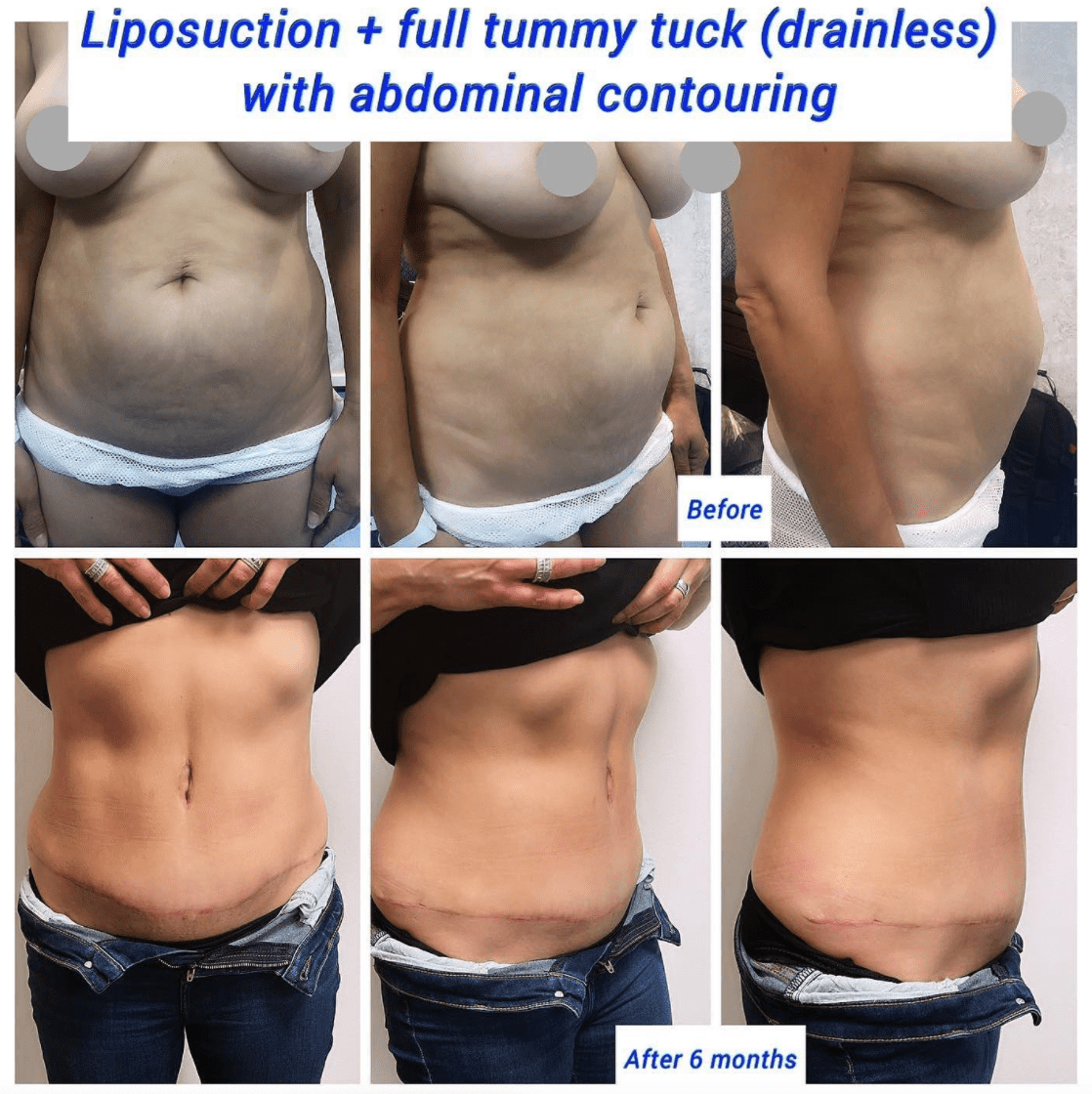 liposuction and drainless tummy tuck with abdominal contouring