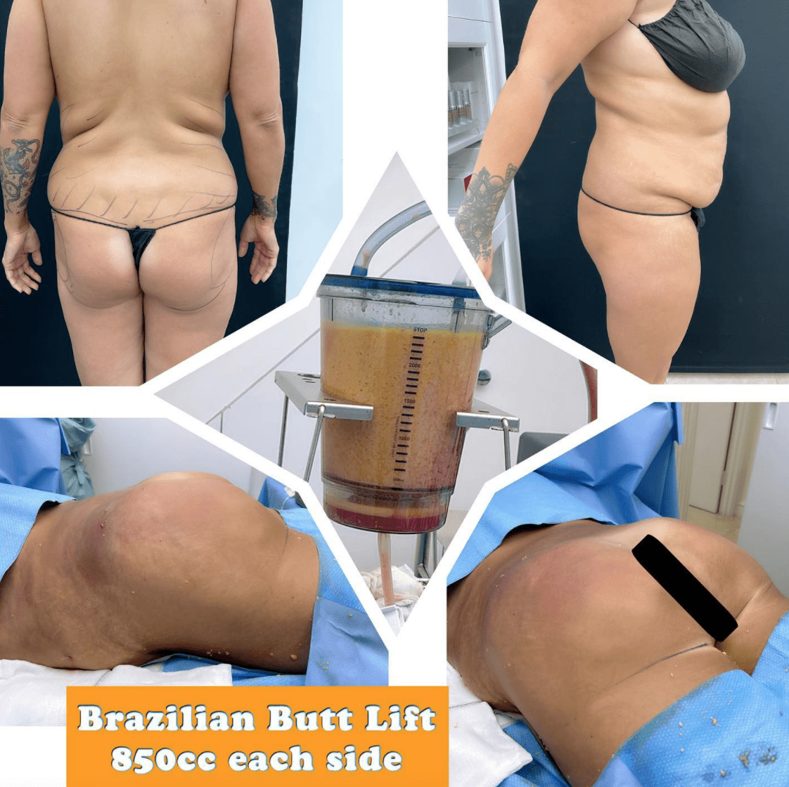 Brazilian butt lift at the Harley Clinic, London