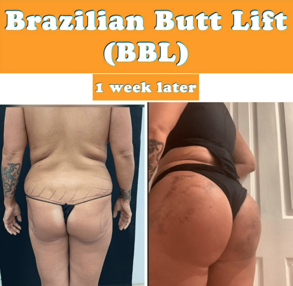 Before and after Brazilian butt lift at the Harley Clinic