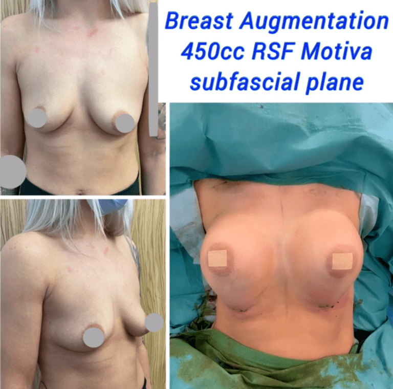 Breast augmentation 450cc RSF Motiva breast implants at the Harley Clinic