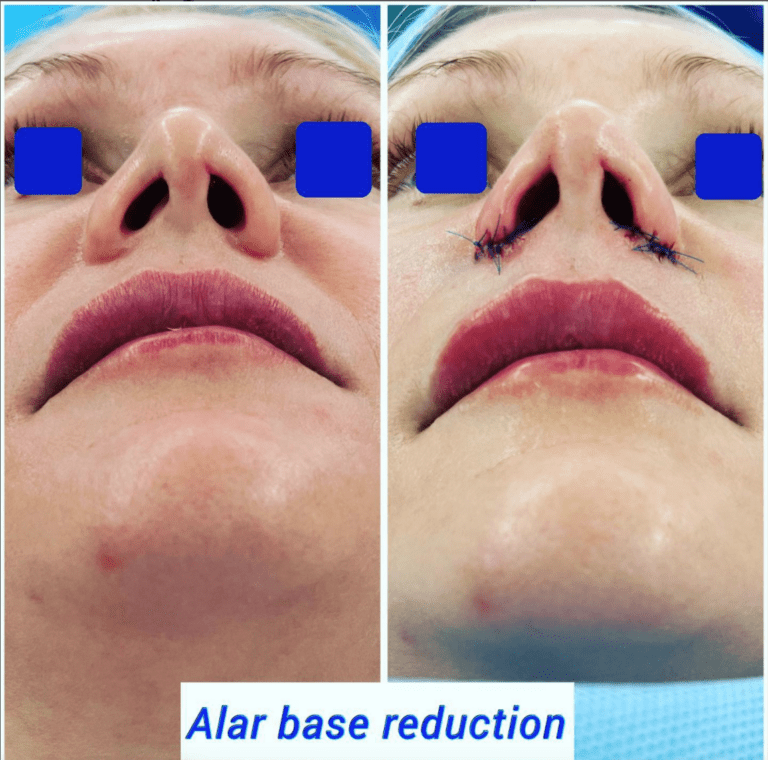 Before and after alar base reduction at the Harley Clinic