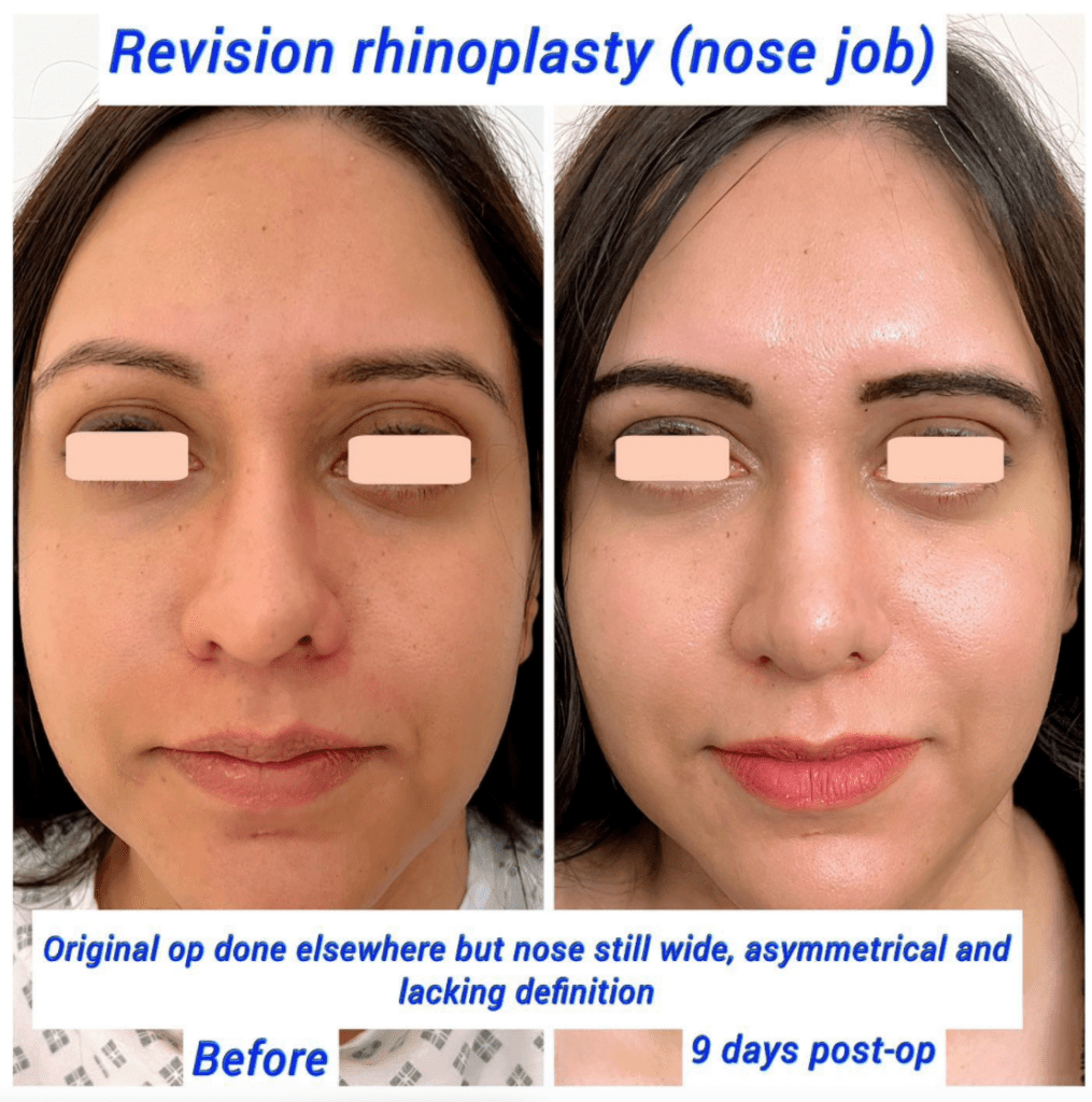 Antes y después de la rinoplastia de revisión de nariz en Harley Clinic