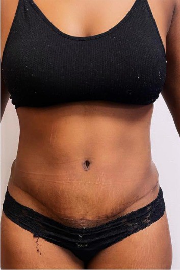 Before and after tummy tuck at the Harley Clinic
