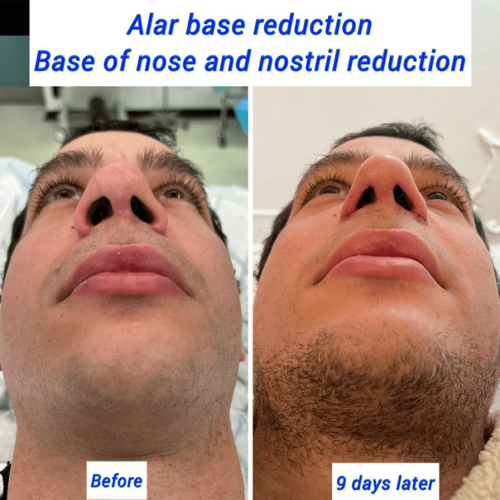 Alar base reduction before and after