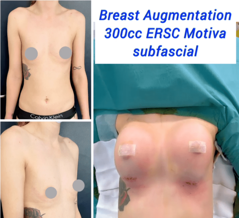 Breast augmentation, 300cc ERSC Motiva subfascial at the Harley Clinic