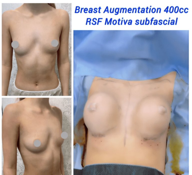 Breast augmentation, 400cc RSF Motiva subfascial at the Harley Clinic London