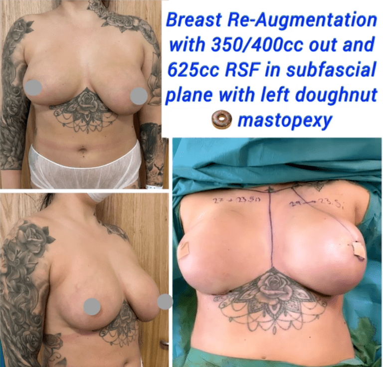 Breast re-augmentation and lift
