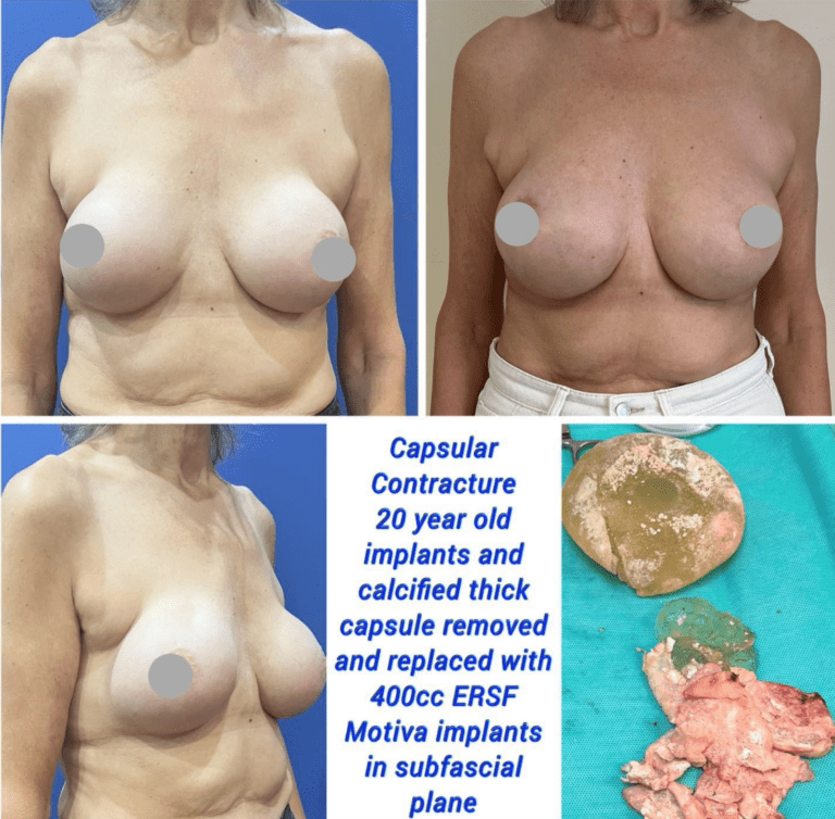 Capsular contracture, breast implants