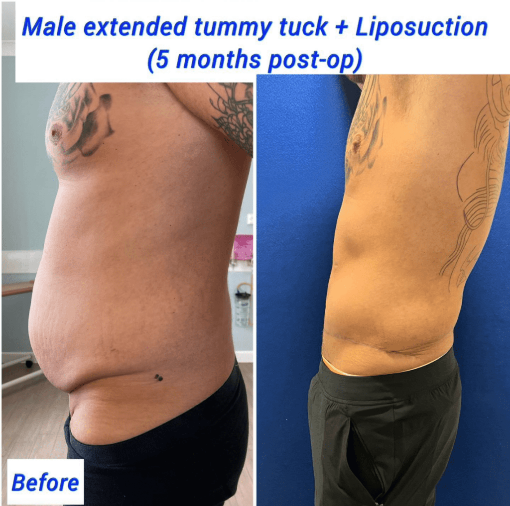 Tummy Tuck for Men: Here's What to Expect - Harley Clinic