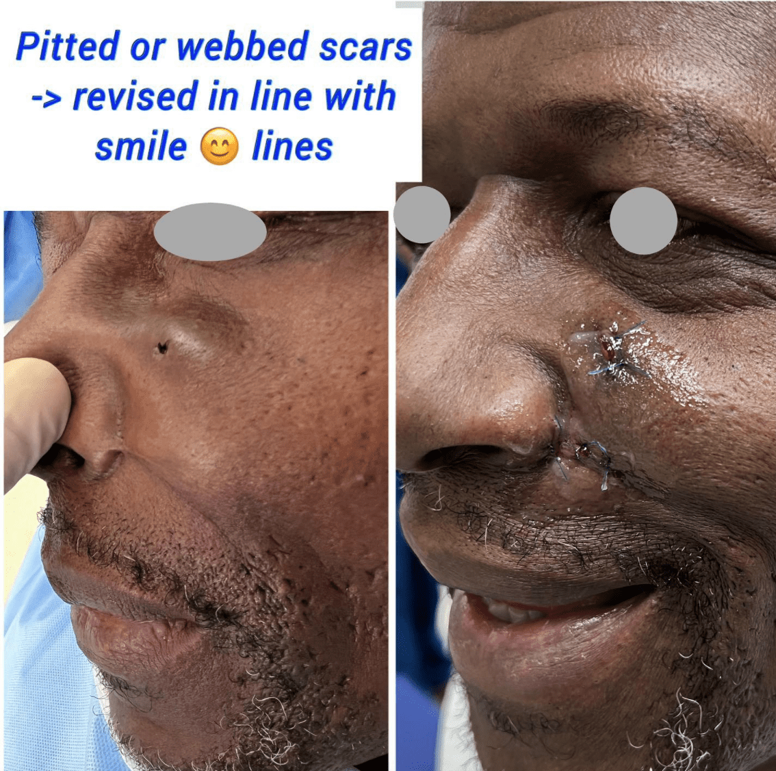 Pitted or webbed scars at the Harley Clinic London