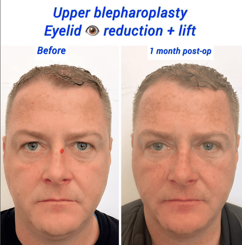 Preparación para la cirugía de párpados: Reducción y levantamiento de párpados, blefaroplastia superior antes y después