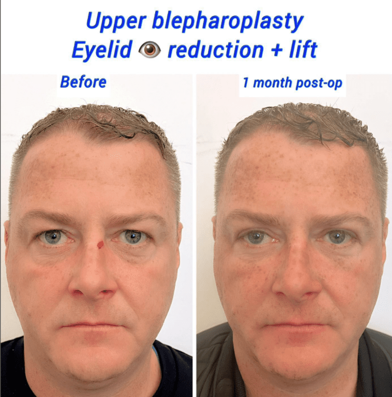 Prepare for eyelid surgery: Eyelid surgery reduction and lift, upper blepharoplasty before and after