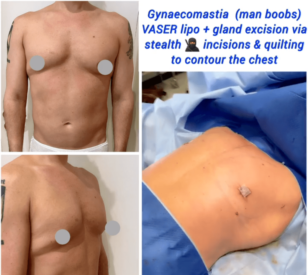 Gynaecomastia, Vaser liposuction and gland excision at the Harley Clinic