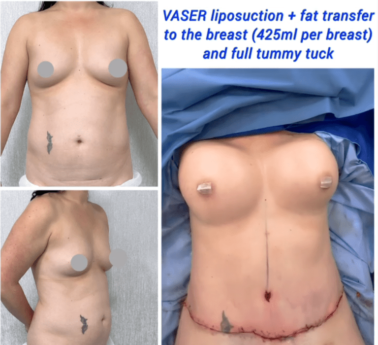 Vaser liposuction and fat transfer to the breast, full tummy tuck at the Harley Clinic