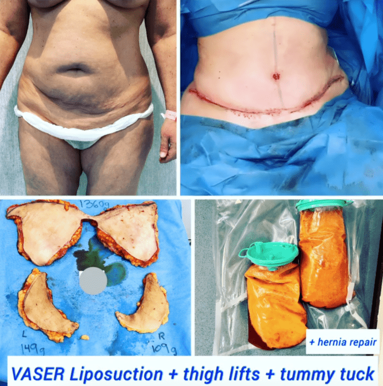 Vaser liposuction, thigh lift, and tummy tuck
