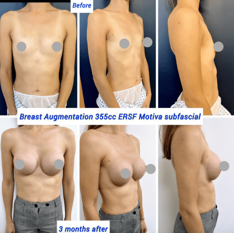 Before and after breast augmentation 355cc ERSF Motiva subfascial
