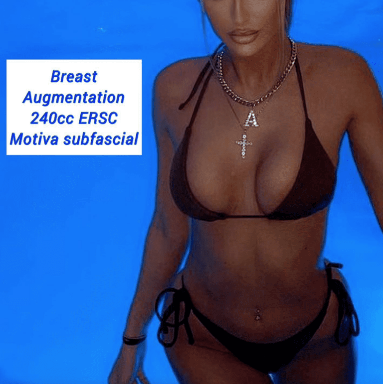 Breast augmentation, 240cc ERSC Motiva subfascial at the Harley Clinic