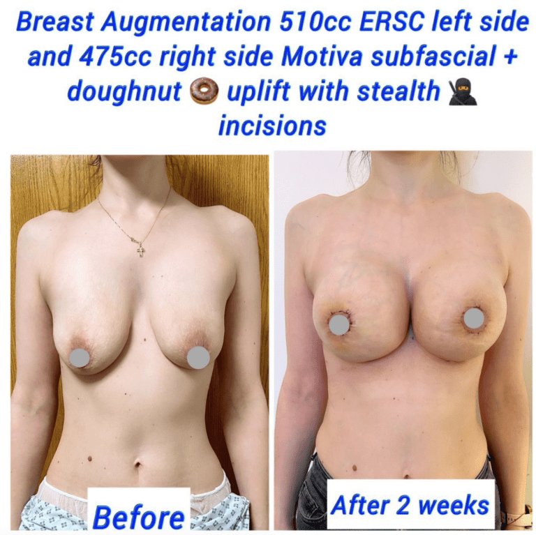 Breast augmentation and uplift before and after