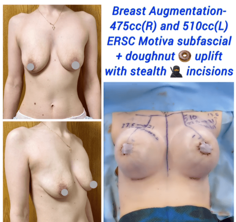 Breast augmentation ERSC Motiva subfascial and doughnut uplift at the Harley Clinic