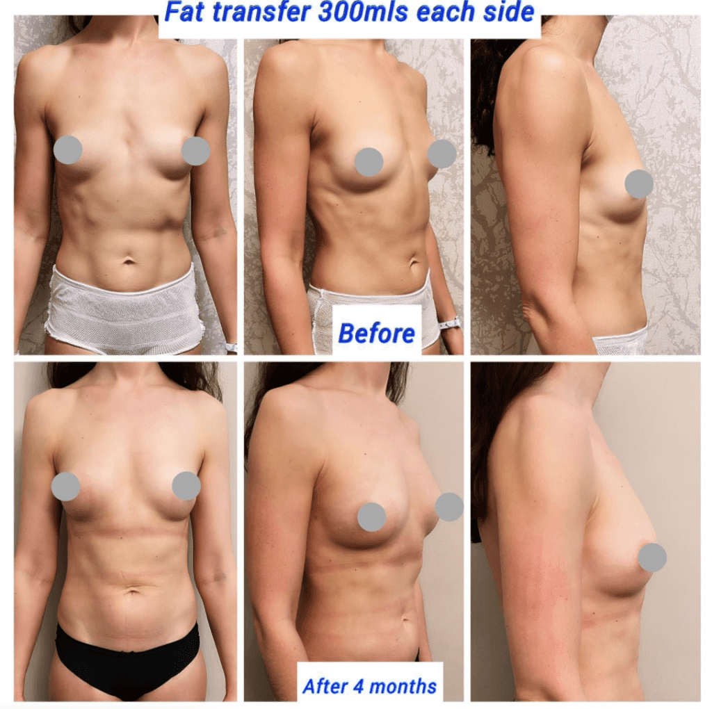 Before and after breast augmentation fat transfer 300mls to each side