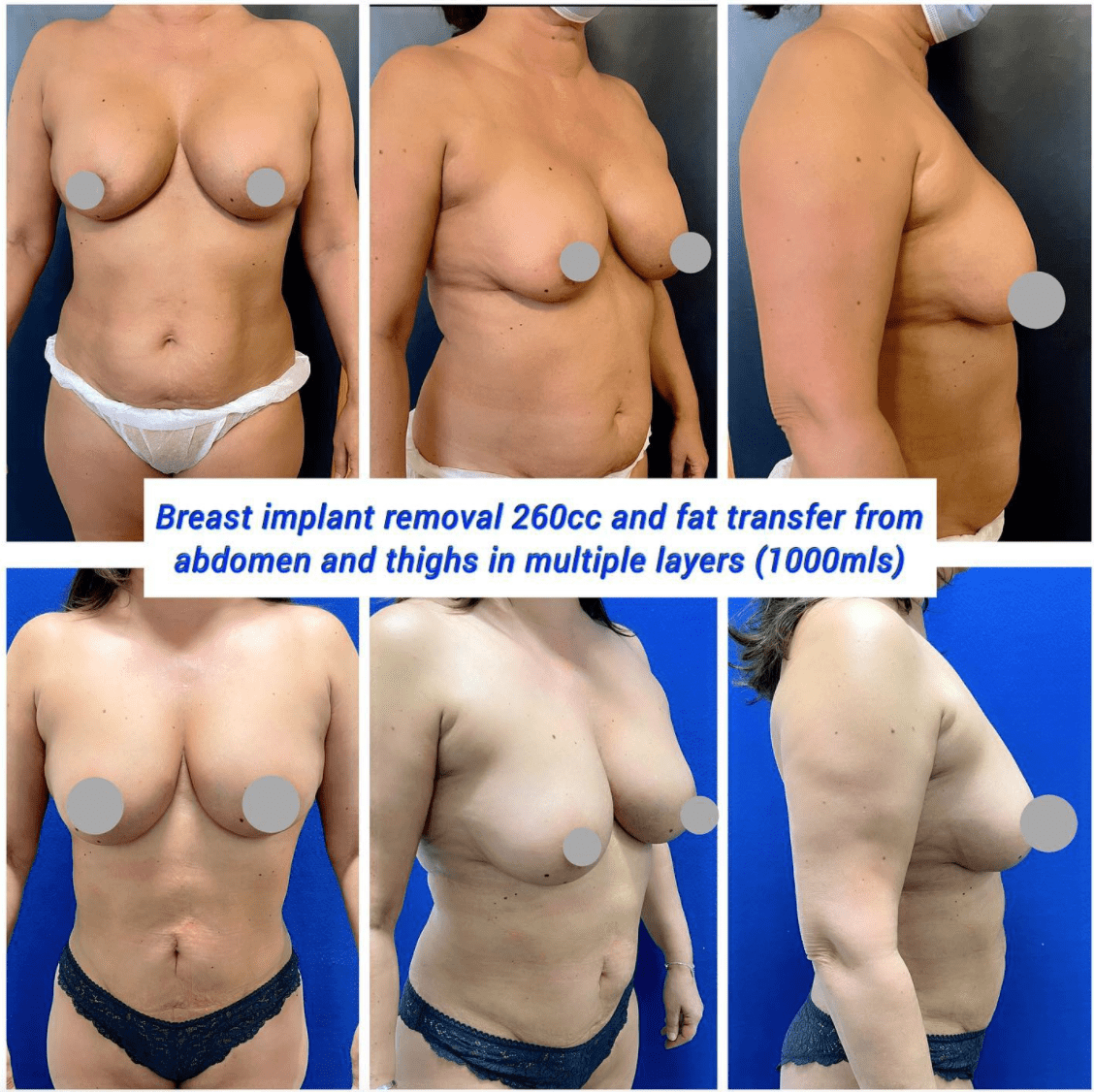 Breast implant removal and fat transfer from abdomen and thighs