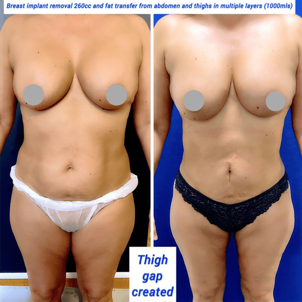 Breast implant removal and fat transfer from tummy and thighs