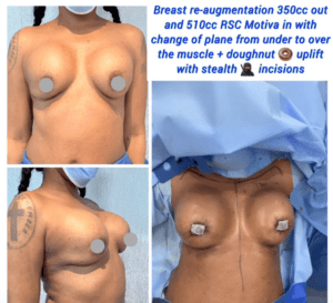 Breast re-augmentation replaced with 510cc RSC Motiva and uplift, the Harley Clinic