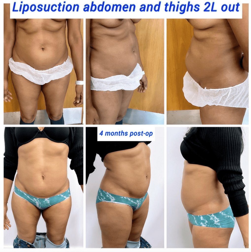Liposuction abdomen and thighs before and after at the Harley Clinic