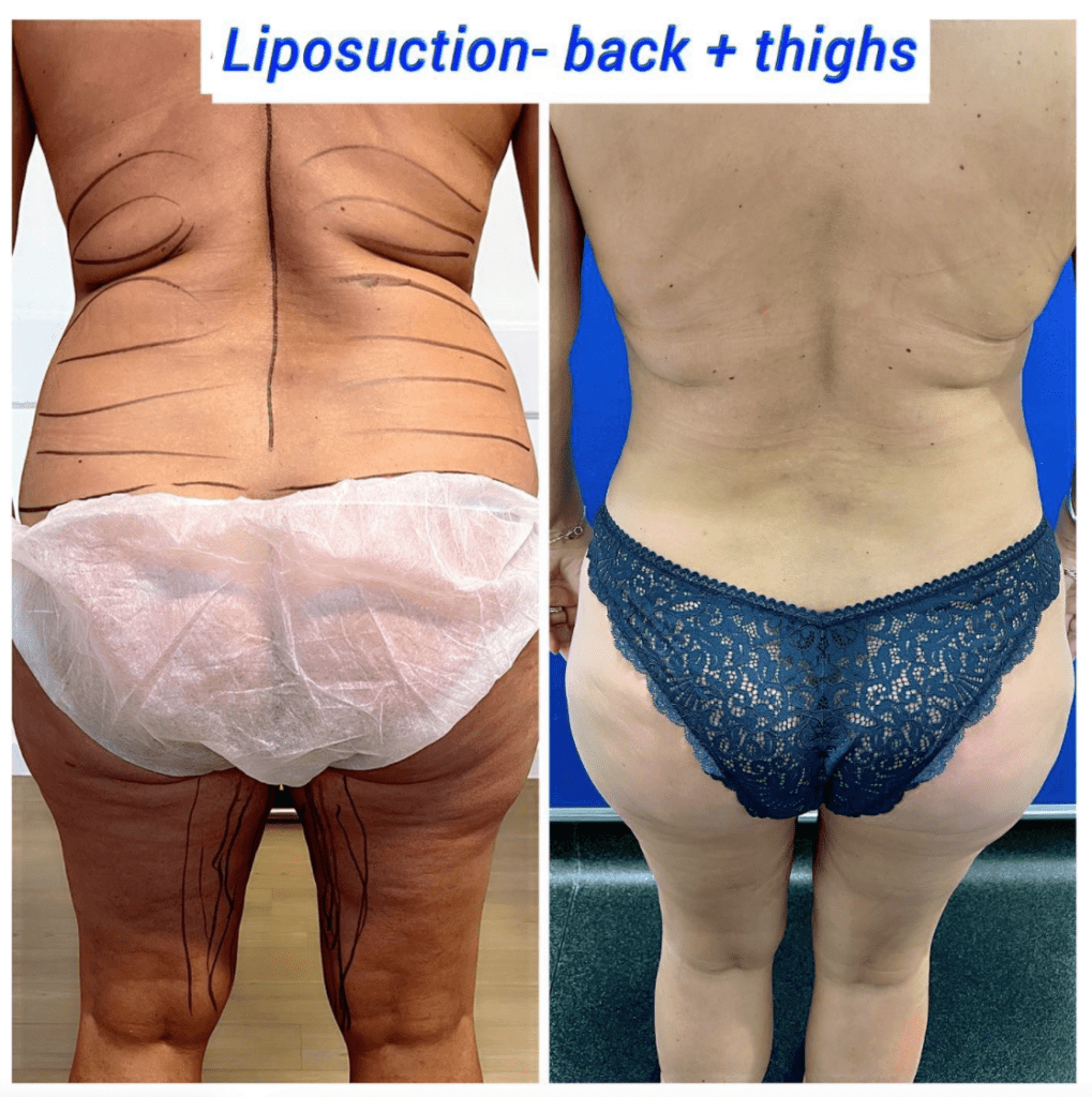 Body contouring surgeries - Liposuction to back and thighs
