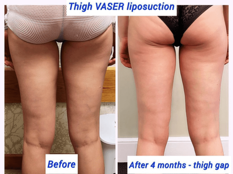 Before and after thigh Vaser liposuction at the Harley Clinic