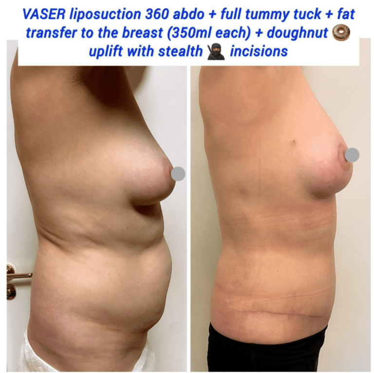 Vaser liposuction, full tummy tuck, breast fat transfer, and doughnut uplift