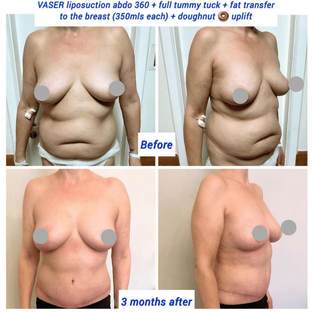 Vaser liposuction, full tummy tuck, fat transfer to the breast and doughnut uplift at the Harley Clinic