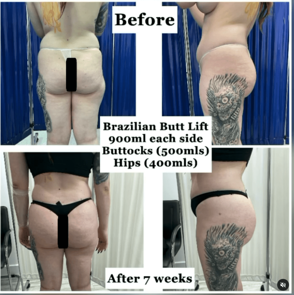 Brazilian Butt Lift before and after - BBL after 7 weeks