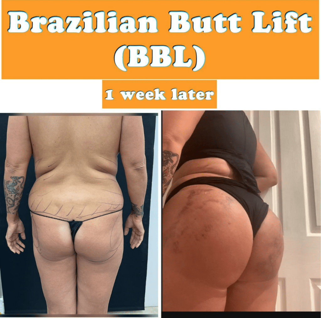 Brazilian Butt Lift BBL after 1 week