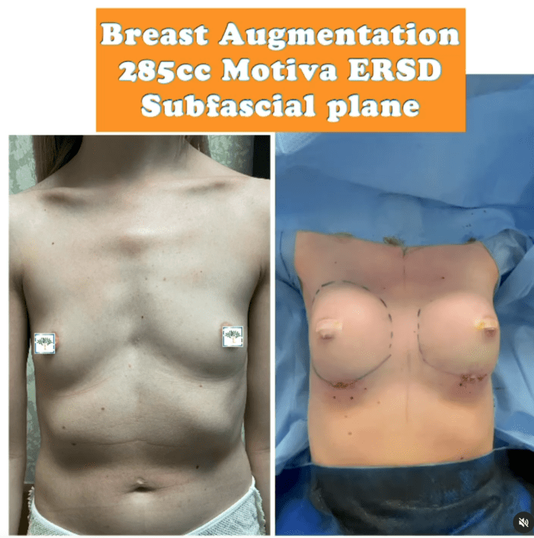 Breast augmentation 285cc Motiva ERSD subfascial plane