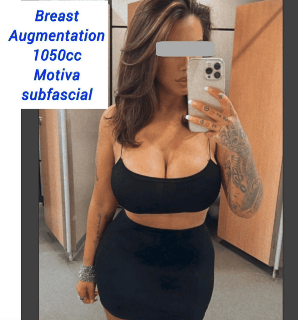 Breast enlargement surgery - 1050cc Motiva subfascial