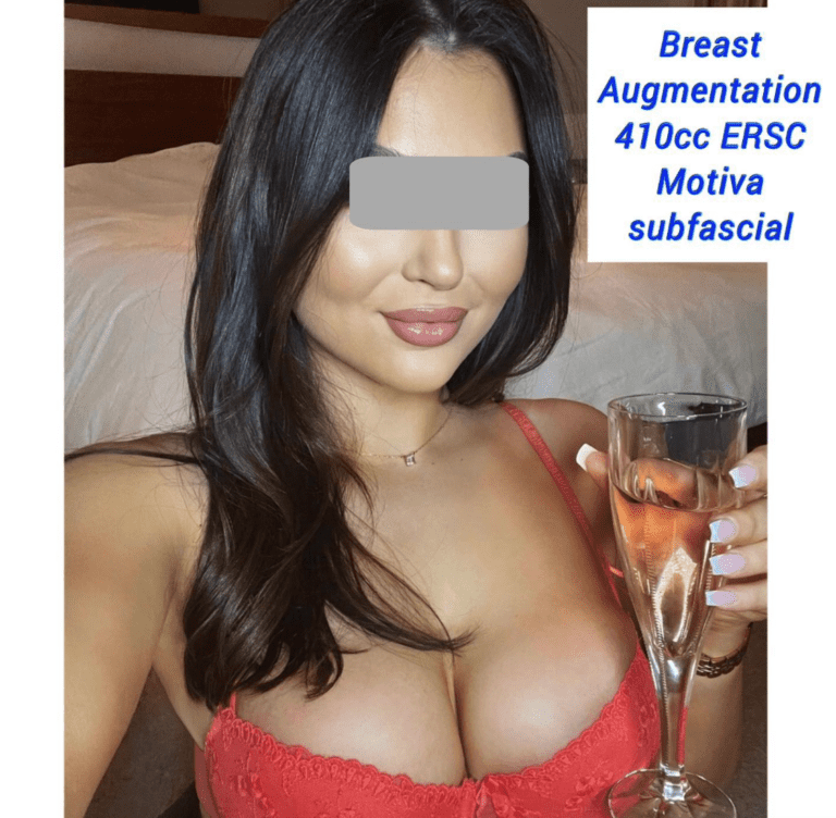Breast augmentation 410cc ERSC Motiva subfascial