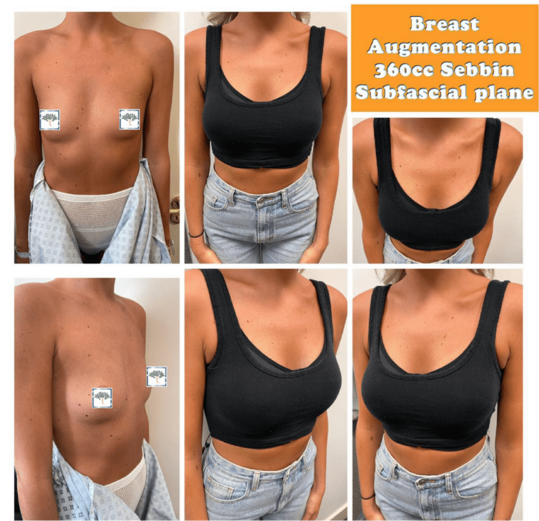 Breast augmentation 360cc
