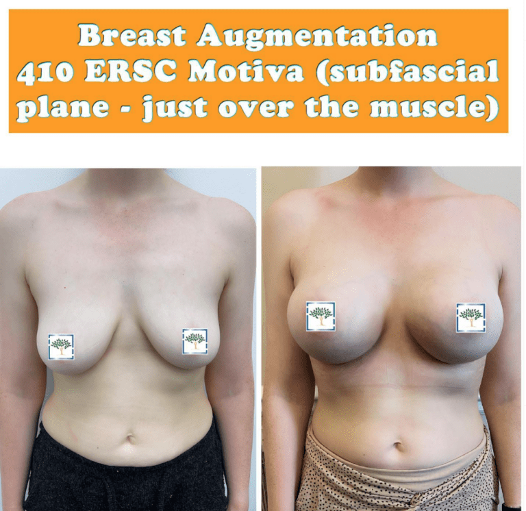 Breast augmentation 410 ERSC Motiva