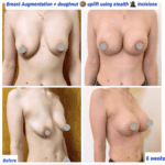 Breast augmentation and breast lift
