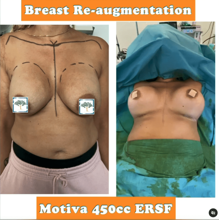 Breast re-augmentation - the Harley Clinic