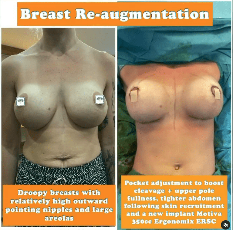 Breast re-augmentation - the Harley Clinic