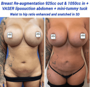 Breast re-augmentation, Vaser liposuction and mini tummy tuck
