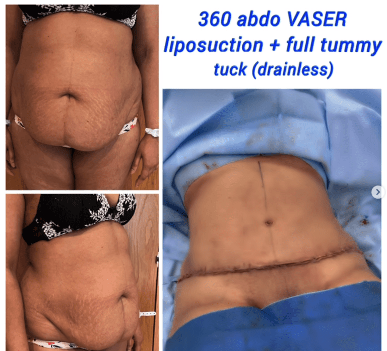 Abdomen vaser liposuction and full drainless tummy tuck at the Harley Clinic