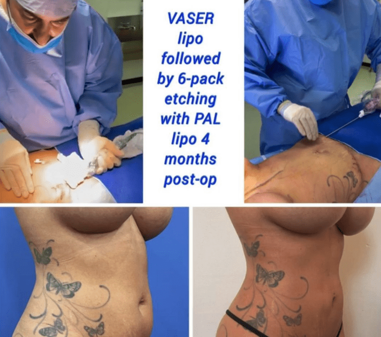Vaser liposuction followed by 6-pack etching with PAL lipo