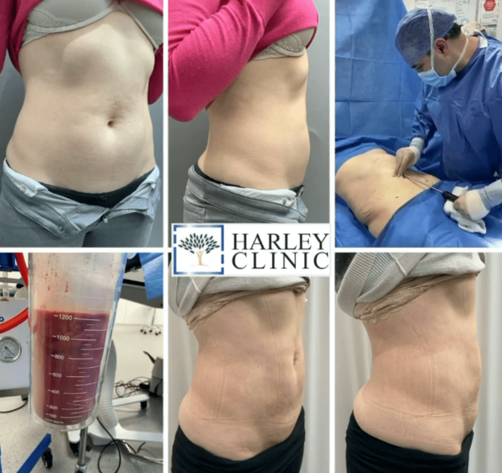 Liposuction with abdominal etching