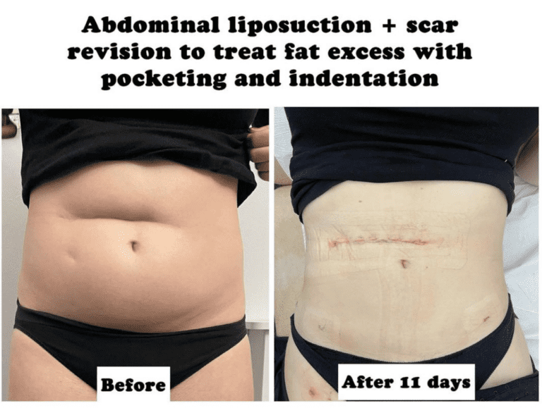 Abdominal liposuction and scar revision surgery